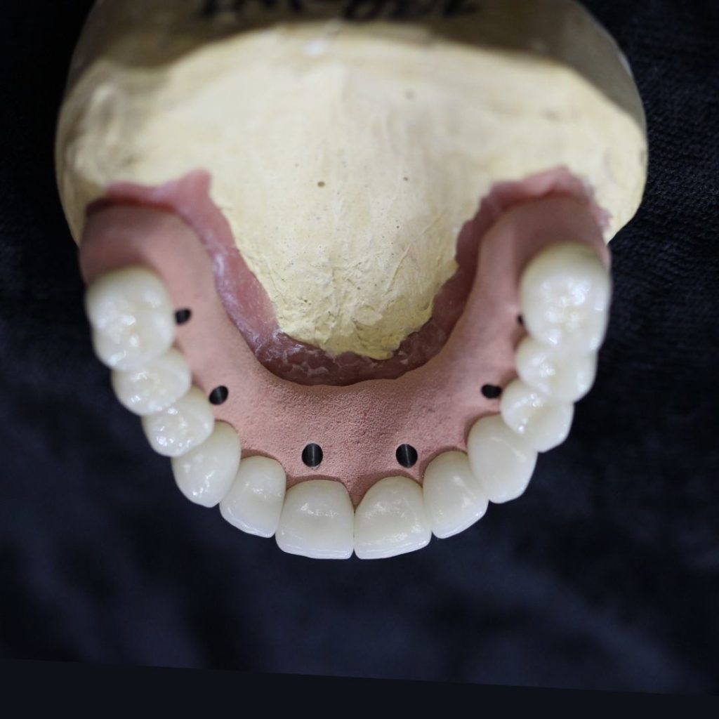 Overdentures and Hybrids New Image Dental Laboratory