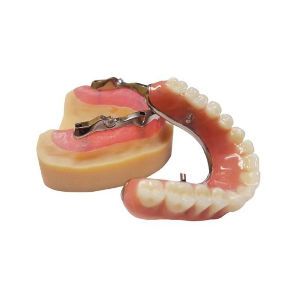 Overdentures And Hybrids - New Image Dental Laboratory