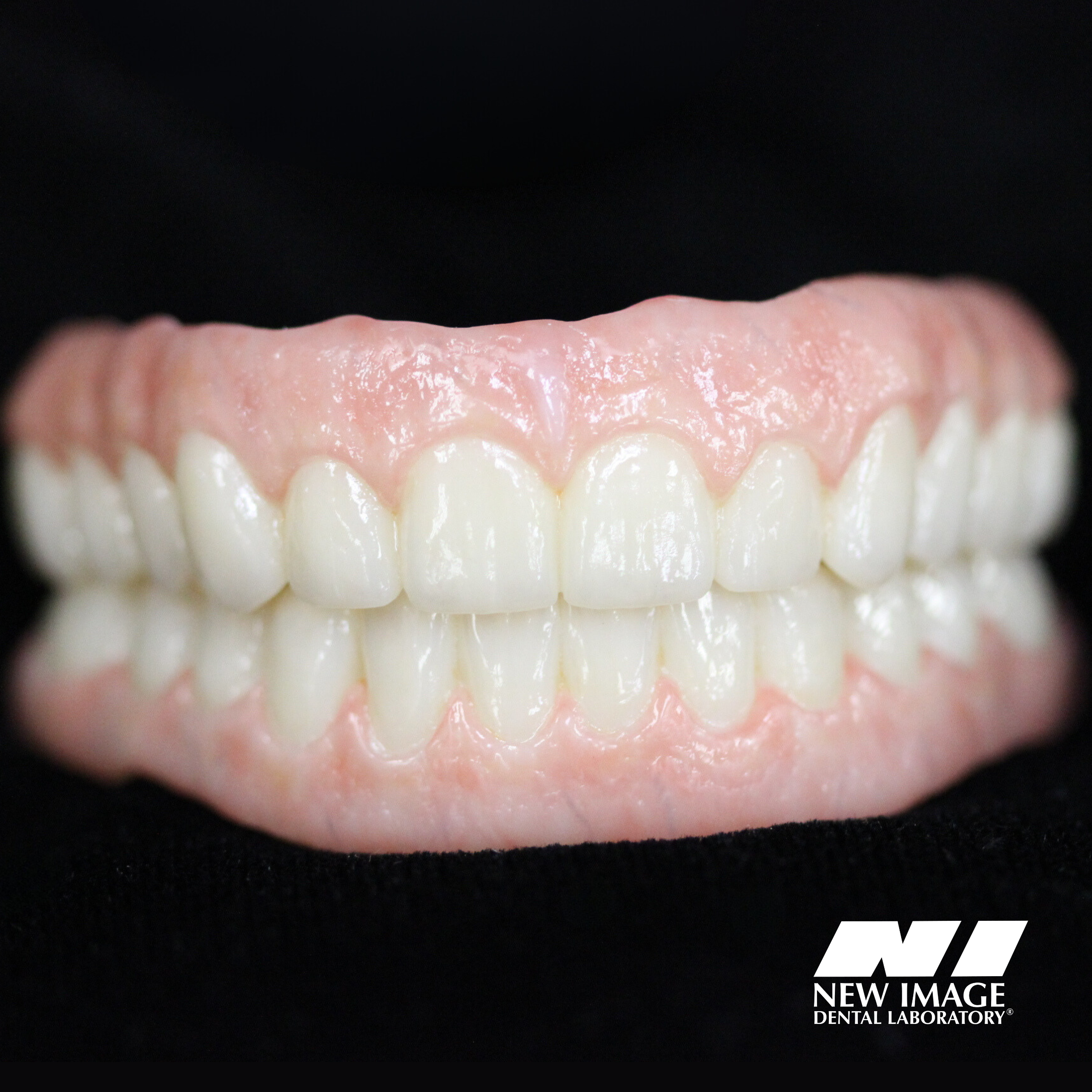 Screw-Retained Milled Zirconia Hybrid Denture